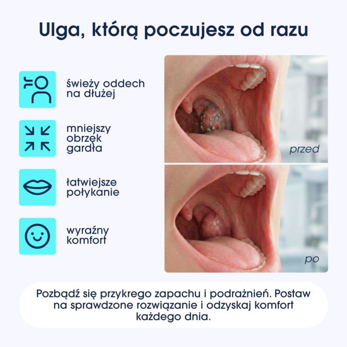 ZENT TonsilCare Urządzenie do oczyszczania migdałków i gardła z podciśnieniem i LED, bezprzewodowy